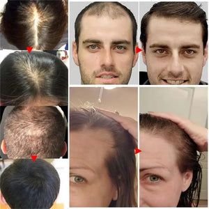 Anti-Hair Loss Oil - Men & Women